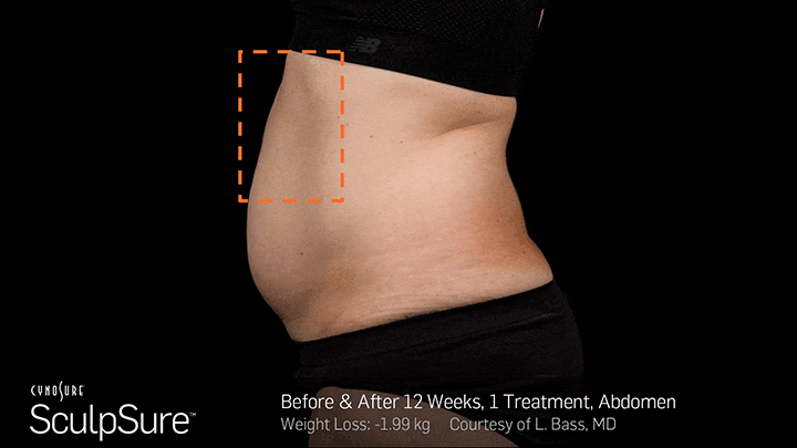 SculpSure®